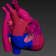 04.png 有心房间隔缺损的心脏 3D 模型