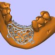 706221_grid_v3-1.jpg Individual mesh membrane for bone reconstruction of the jaw (examples of real operations)