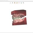 3.jpg Digital Full Dentures for Gluedin Teeth with Manual Reduction