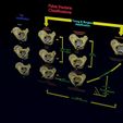 pelvis-fracture-classifications-3d-model-blend-15.jpg Pelvis fracture classifications 3D model