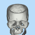 5.png Mandible implant-INDIVIDUAL PROSTHESIS FOR JAW RECONSTRUCTION