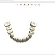 10.jpg Digital Full Dentures for Gluedin Teeth with Manual Reduction