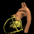 16.png 3D Model of Transposition of the Great Arteries Open Duct