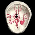 2.jpg 3D Model of Middle Cerebral Artery (MCA) Aneurysm