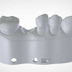 1.png Digital Implant Model with a Metal Analog