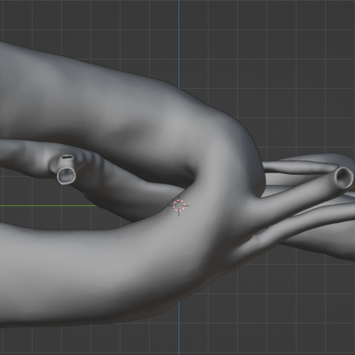 24.png 3D Model of Double Aortic Arch