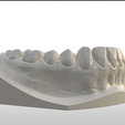 Screenshot_26.png Digital Full Coverage Occlusal Splint with Canine Guidance