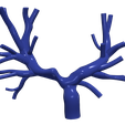 chd2.png.7779bfcea8840d80731d2076cc3d96a5.png 3D Model of Pulmonary Arteries (Fontan Procedure)