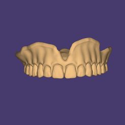 Clipboard-2024-06-11-18-57-27.jpg DIGITAL TOTAL REMOVABLE DENTURES (upper + lower + artificial teeth) 10 stl files