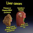 liver-cancer-hcc-vs-metastatic-3d-model-cda96ae0c4.jpg Liver cancer HCC vs Metastatic 3D model