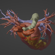 5.png 3D Model of Human Heart with Atrio-Ventricular Septal Defect (AVSD) - generated from real patient