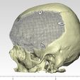Skull_porous_plate_2.jpeg Cranial plate made according to anthropometric data (an interesting case)