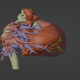 3.png 3D Model of Human Heart with Ventricular Septal Defect (VSD)