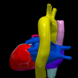 5.png 3D Model of Bicuspid Aortic Valve (BAV)