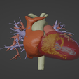 1.png 3D Model of Human Heart with Hypertrophic Cardiomyopathy - generated from real patient