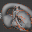 22.png Modèle 3D de la valve aortique bicuspide (BAV)