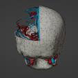 w2.png 3D Model of Brain Arteriovenous Malformation