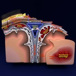 sig2.jpg Archivo STL Modelo de tipos de hemorragia cerebral・Diseño de impresora 3D para descargar