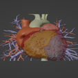 1.png 3D Model of Human Heart with Pulmonary Artery Sling (PAS) - generated from real patient