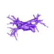 STL00003.stl Model of human heart with pulmonary atresia (PuA) - generated from real patient