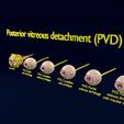 posterior-vitreous-detachment-types-eye-3d-model-blend-81.jpg Posterior vitreous detachment types eye 3D model