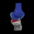 2.png 3D Model of Knee - generated from a real patient