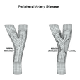 Artery_Wireframe_2.png Peripheral Artery Disease