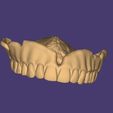 Clipboard-2024-12-21-00-45-42.jpg DIGITAL TOTAL UPPER REMOVABLE DENTURE - 3 stl files (base + teeth + monoblock)