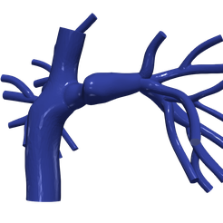 chd.png.25a68748c10bcac4c80246a6b75d8c05.png Modèle 3D des artères pulmonaires (procédure Fontan)