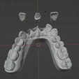 2.png Dental model with removable dies