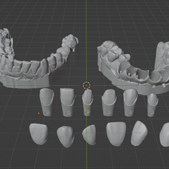 1.png Crowns and veneers on dental model with removable dies