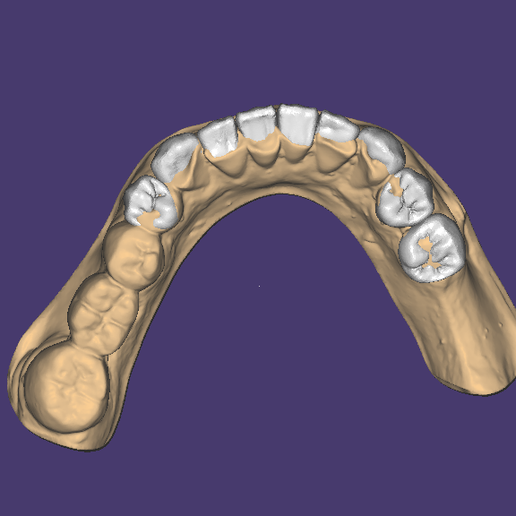 OCLUSAL-INF.png ENCERADO / MOCK-UP #2