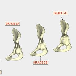 normal pelvis GRADE 2A GRADE 1 GRADE 2C GRADE 2B GRADE 3B GRADE 3A Archivo STL Clasificación de Paprosky de la pérdida ósea acetabular・Modelo para descargar y imprimir en 3D, 3D_PRINTING