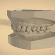 Screenshot_20.png Digital Orthodontic Study Models with Virtual Bases