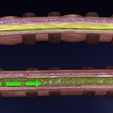fd2.jpg 3D Asthma bronchiole obstruction model
