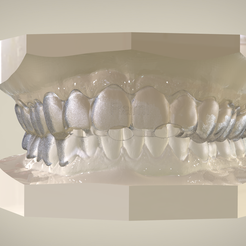 Screenshot_4.png STL file Digital Tooth Positioner・3D print model to download