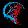 i7.jpg 3D Model of Brain Arteriovenous Malformation