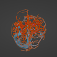 uv11.png 3D Model of Brain Arteriovenous Malformation