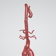 p2.png Case 1 to 6: 3D aortic and iliac artery aneurysm