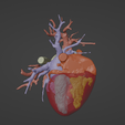 6.png 3D Model of Human Heart with Double Outlet Right Ventricle (DORV) - generated from real patient
