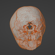 w3.png 3D Model of Middle Cerebral Artery (MCA) Aneurysm
