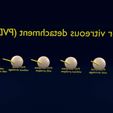 posterior-vitreous-detachment-types-eye-3d-model-blend-77.jpg Posterior vitreous detachment types eye 3D model