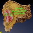 liver-cancer-hcc-vs-metastatic-3d-model-838f0ac4f7.jpg Cancer du foie HCC vs métastatique Modèle 3D