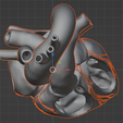 20.png 3D Model of Partial Anomalous Pulmonary Venous Connection