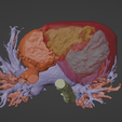 6.png 3D Model of Human Heart with Patent Ductus Arteriosus (PDA) - generated from real patient