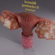 image-0016.jpg Krukenberg ovarian cancer tumor