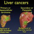 liver-cancer-hcc-vs-metastatic-3d-model-81a80cc441.jpg Liver cancer HCC vs Metastatic 3D model