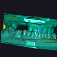 2022-06-08_00028-003.dentalCADscreenshot.png Scanned and mounted study models in exocad