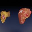 liver-cancer-hcc-vs-metastatic-3d-model-78e78d2e26.jpg Liver cancer HCC vs Metastatic 3D model