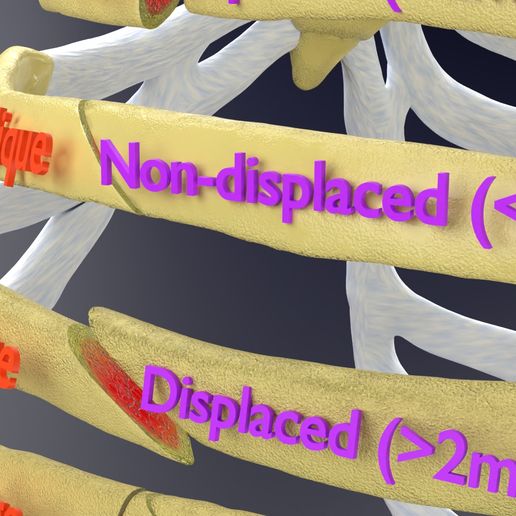 STL file Rib fracture and its types 🦴 ・Design to download and 3D print ...